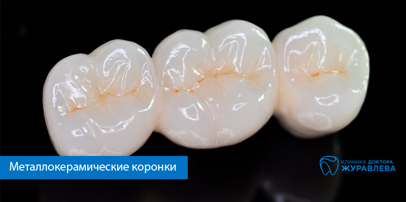 металлокерамическая коронка на зуб