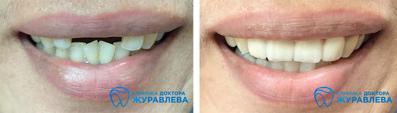 зубной мост на передних верхних зубах из четырех коронок на два зуба