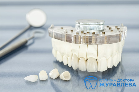 Коронки на передние зубы - как правильно сделать выбор?